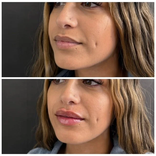 lip filler.JPG