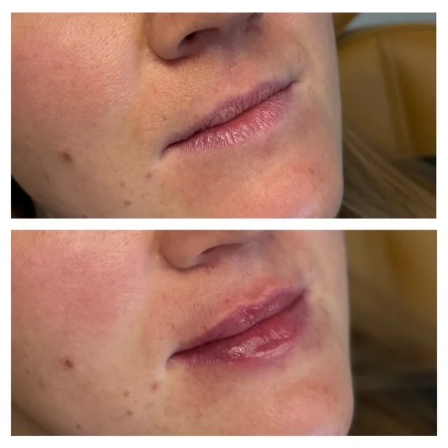 lip filler.JPG