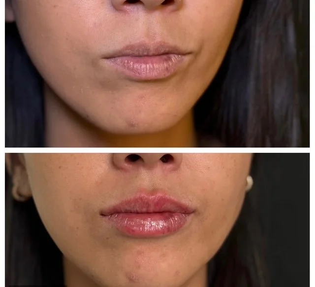 lip filler.JPG