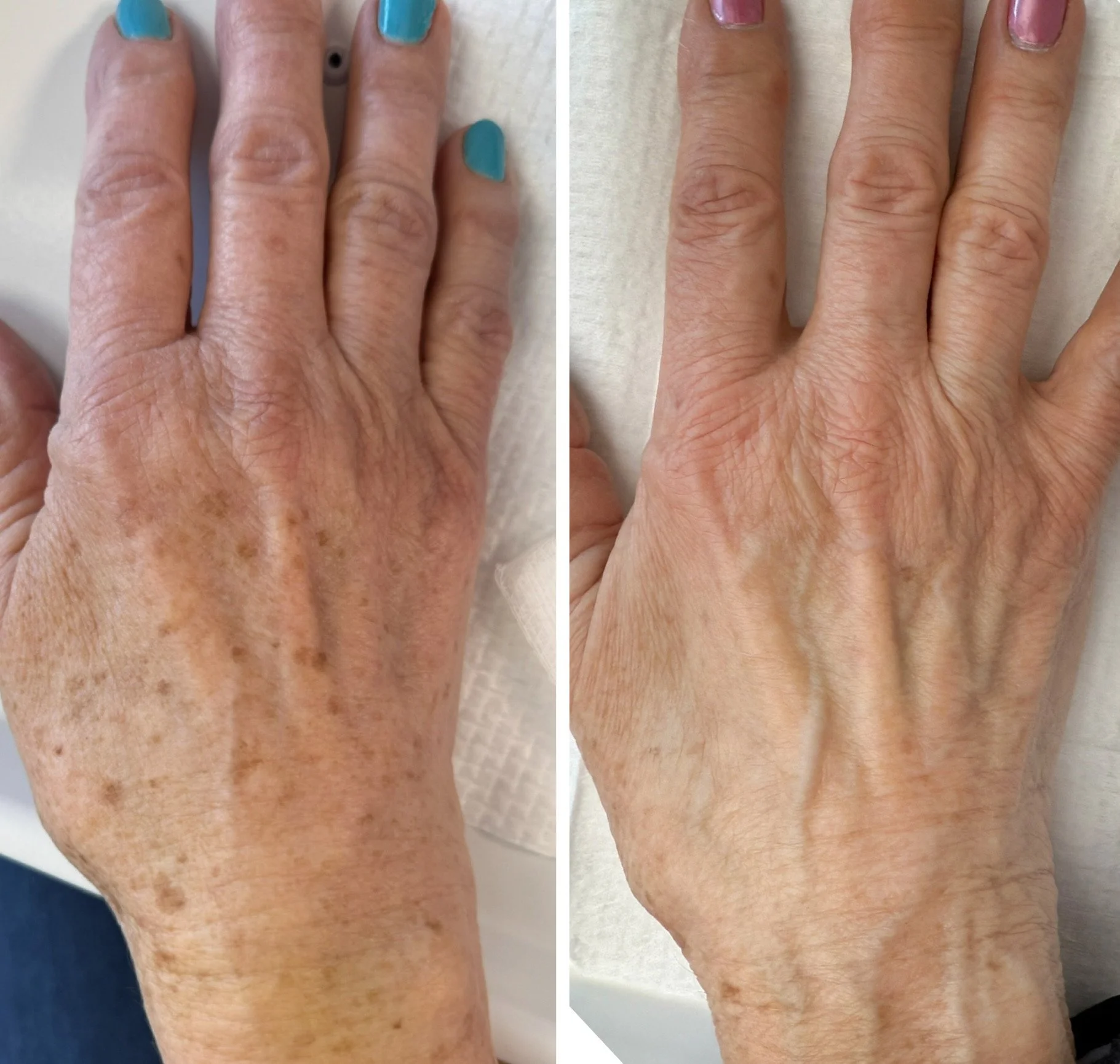 Comparison of a hand before and after skincare treatment, showing reduced age spots and improved skin texture.