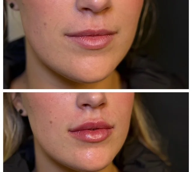 lip filler.JPG