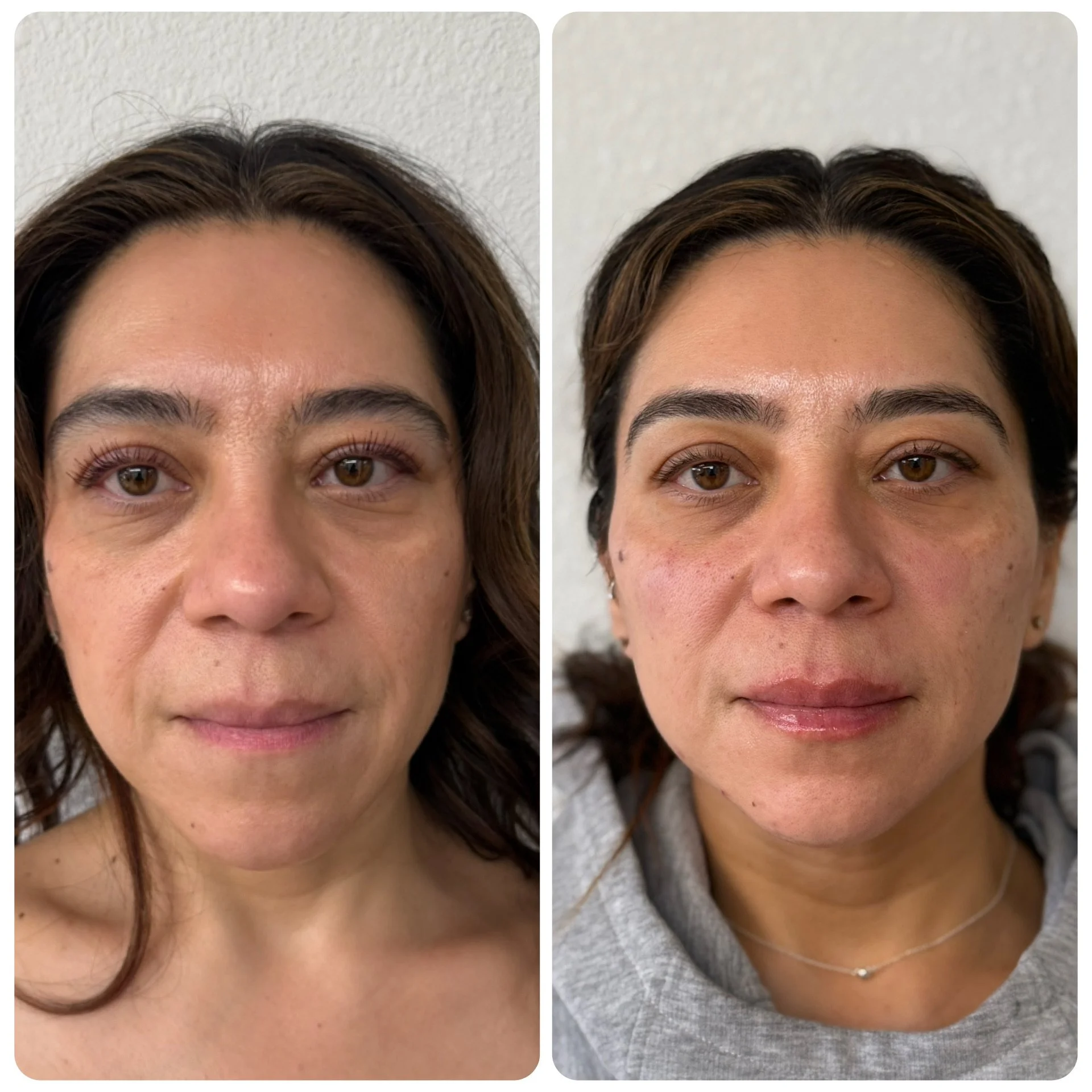 Comparison of a woman's face before and after skincare treatments, showing improvements in skin texture and appearance.