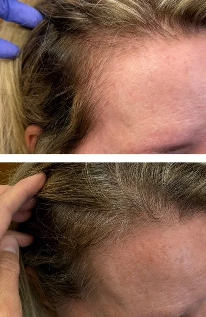 exosomes hair restoration.JPG