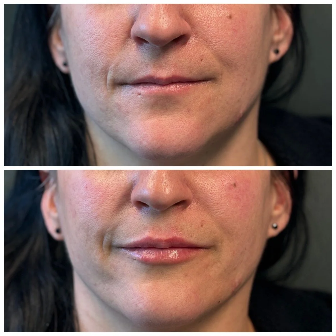 Close-up of a woman's face before and after skincare treatment, showing improved skin texture, reduced redness, and shinier lips.