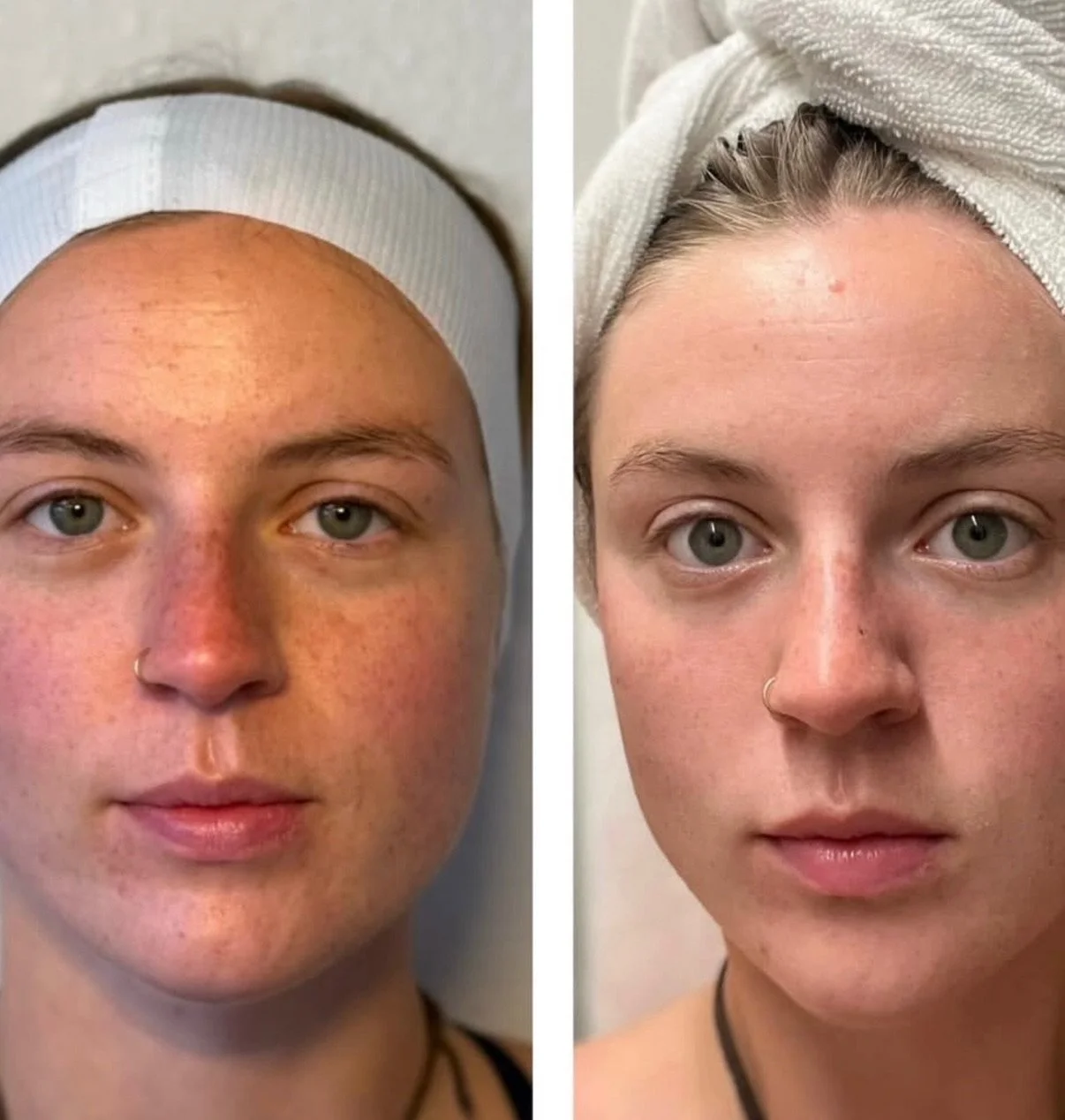 Comparison of a woman's face before and after skin treatment, with the woman wearing a white headband in both images.