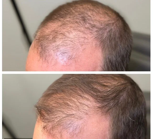 exosomes hair restoration.JPG