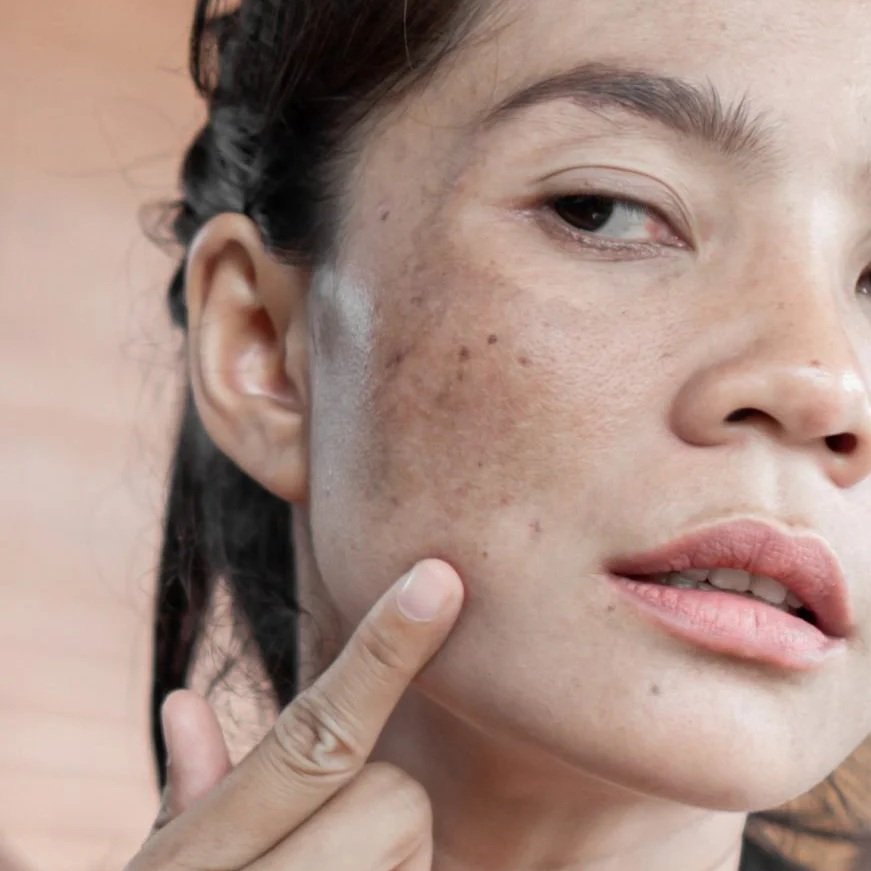 Understanding Efudex: Clearing Sun Damage the Smart Way