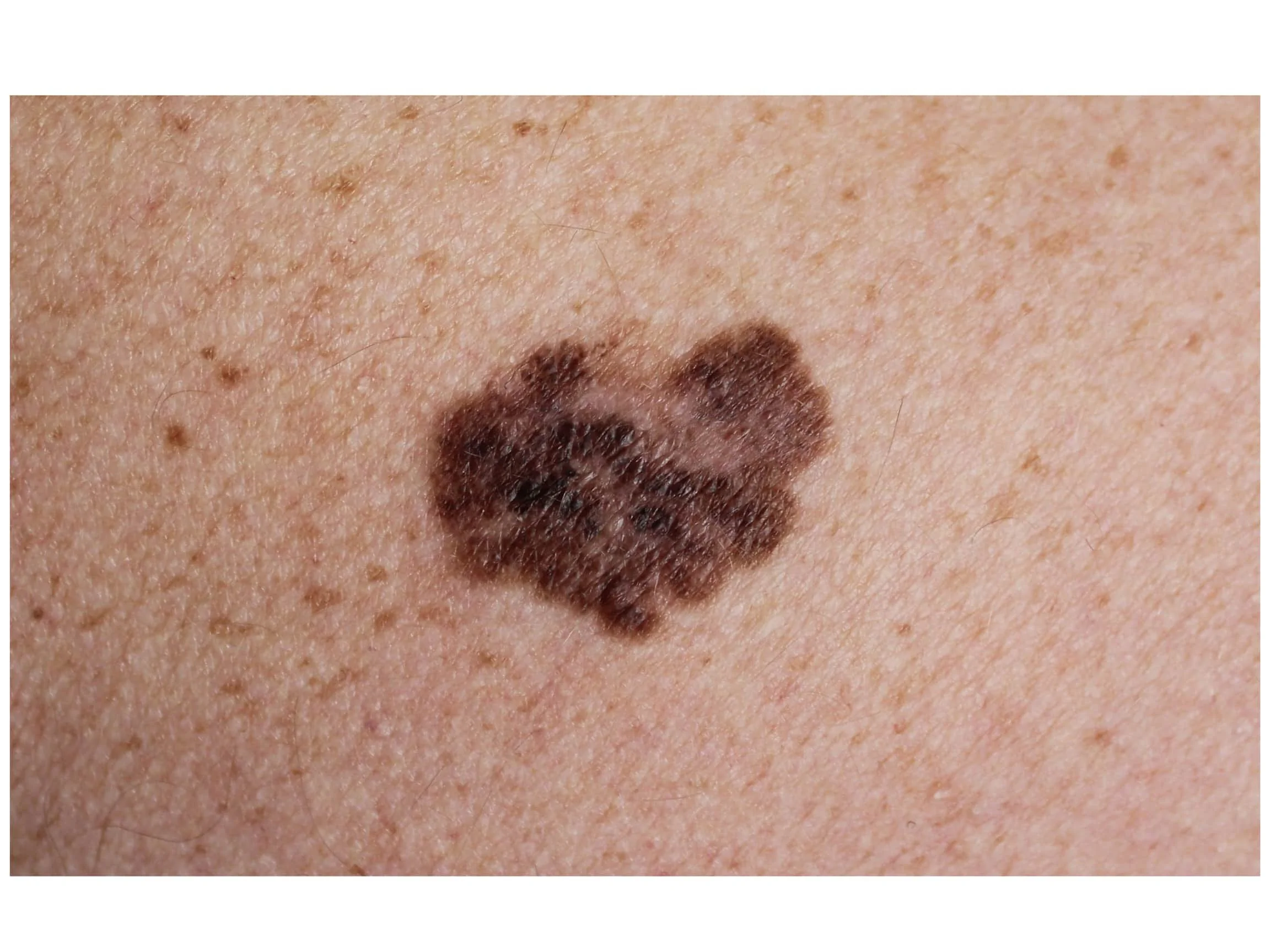 melanoma skin cancer screening doctor cary dermatology raleigh apex