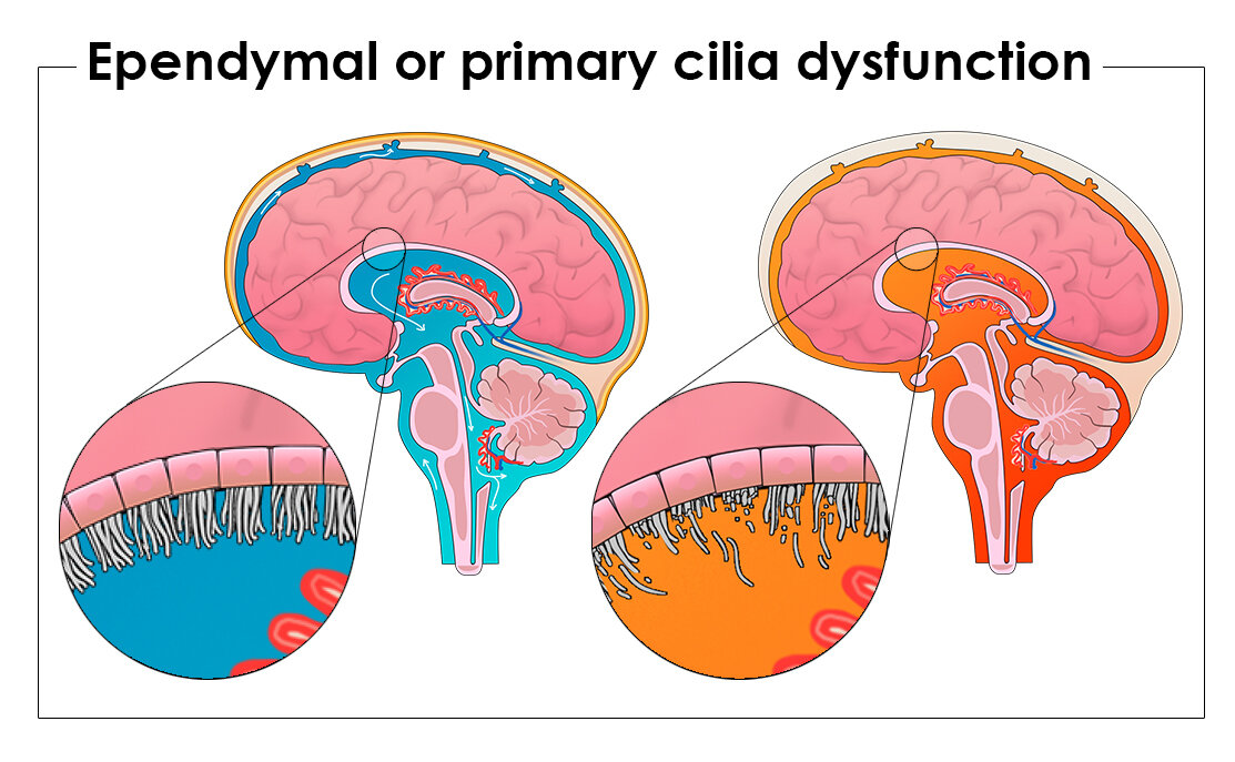 Ependymal or Primay Cilia Dysfunction.jpg