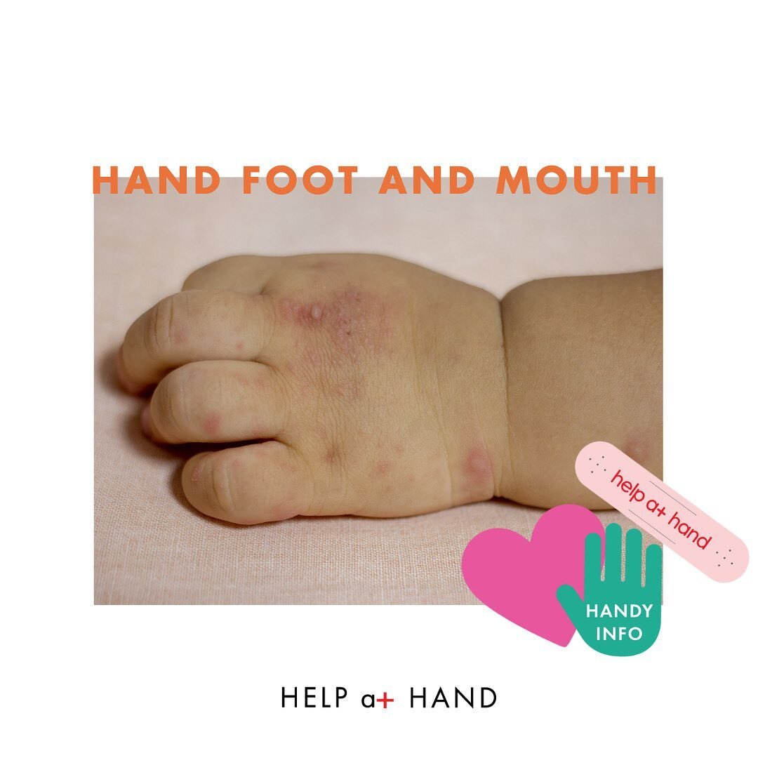 Hand Foot and Mouth is a common childhood infection seen in children under 10 that is caused by a virus. Hand foot and mouth is highly contagious.
⠀⠀⠀⠀⠀⠀⠀⠀⠀
🚨Signs and symptoms🚨
Two different types of Rashes depending on what strain your little hum