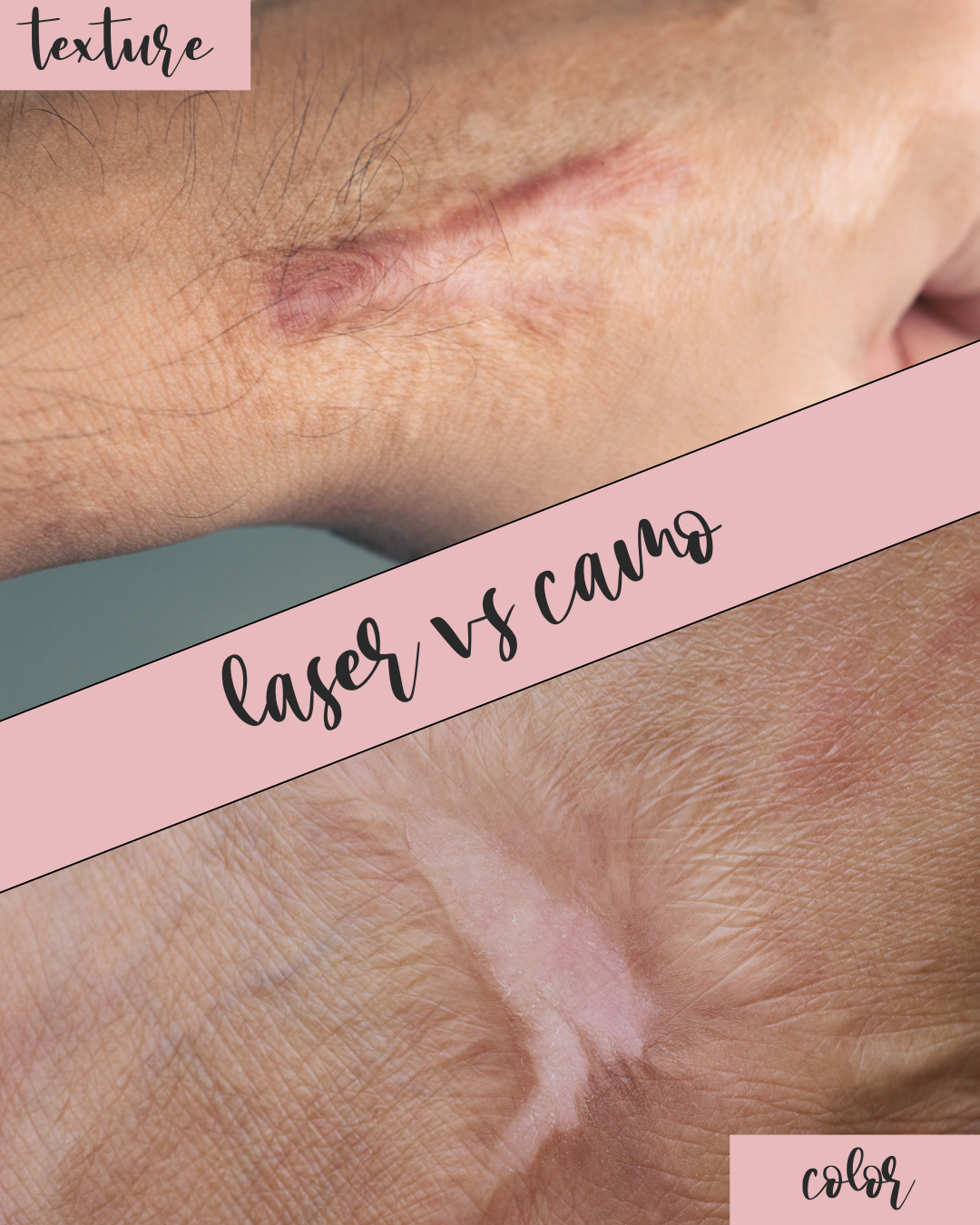 does laser change skin color? understanding laser vs camouflage tattooing