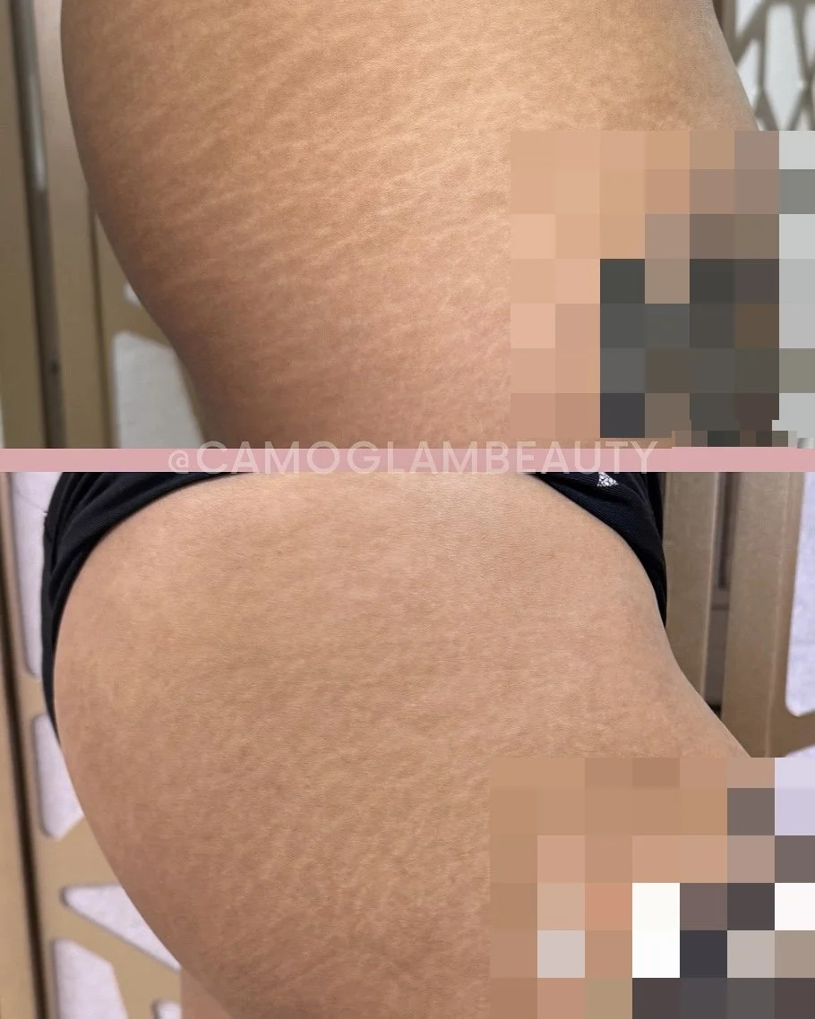 stretch mark camouflage: why subtle results after the first session are part of the process