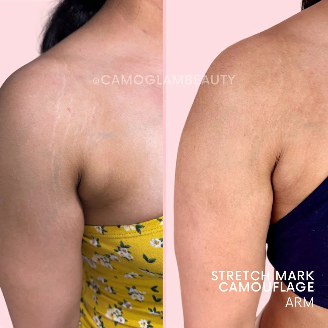 results after one session of stretch mark camouflage on the arm