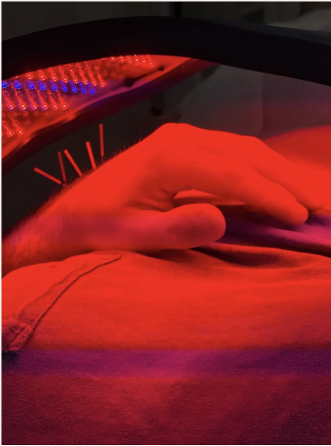 Hand with Dry Needling under blue light