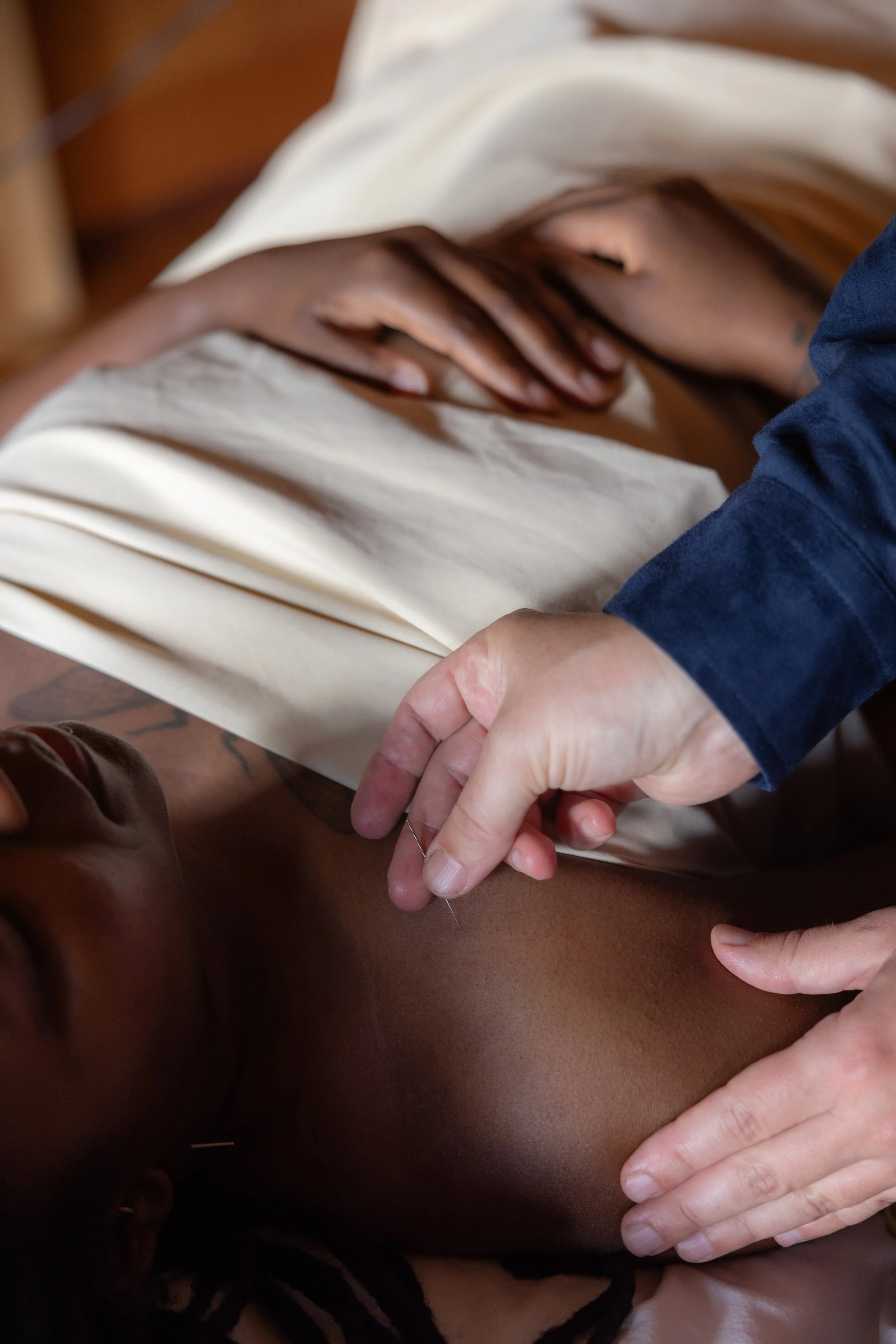 Why Acupuncturists Are the Gold Standard for Needle-Based Therapies