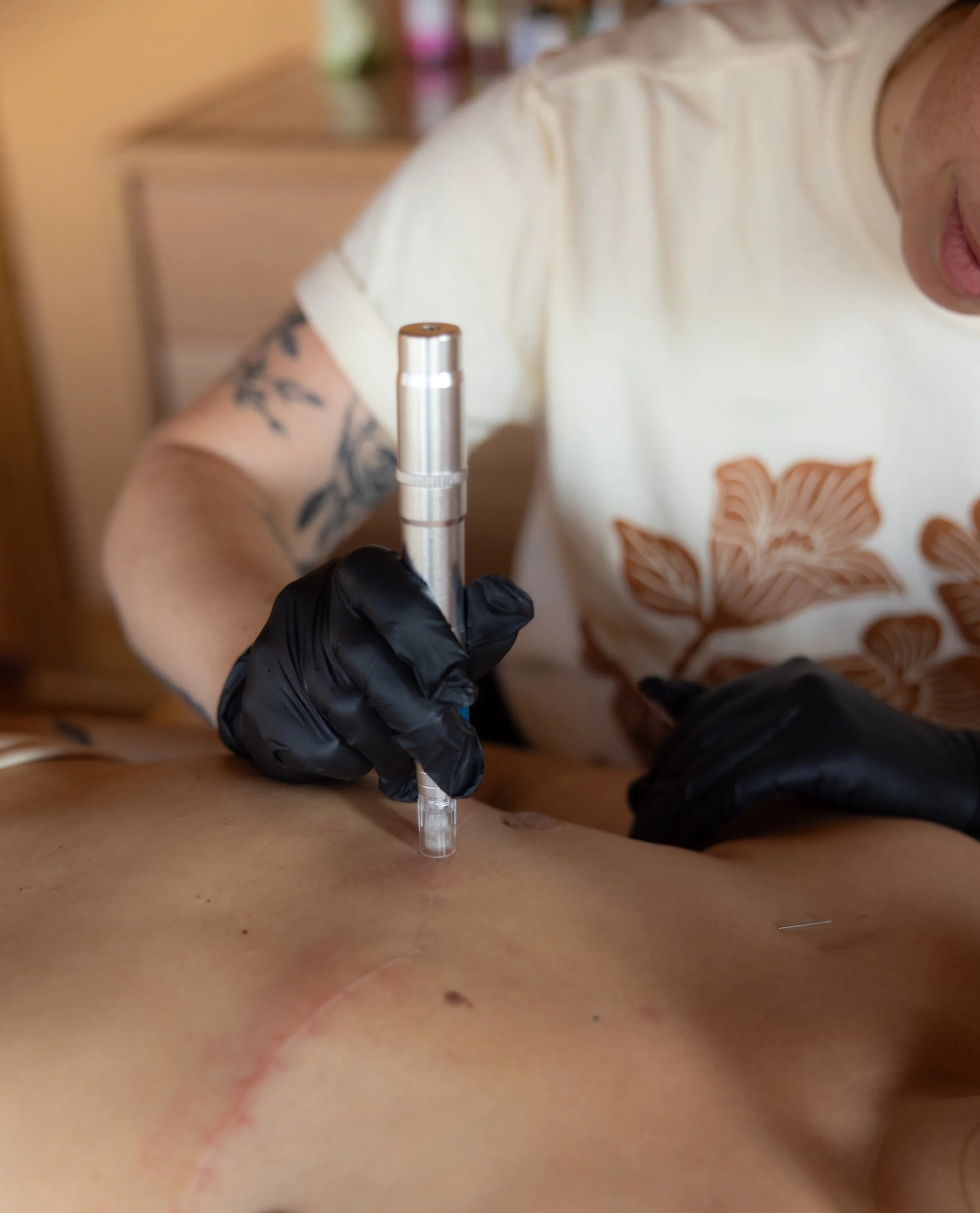 Why Would I Choose An Acupuncturist for Microneedling?