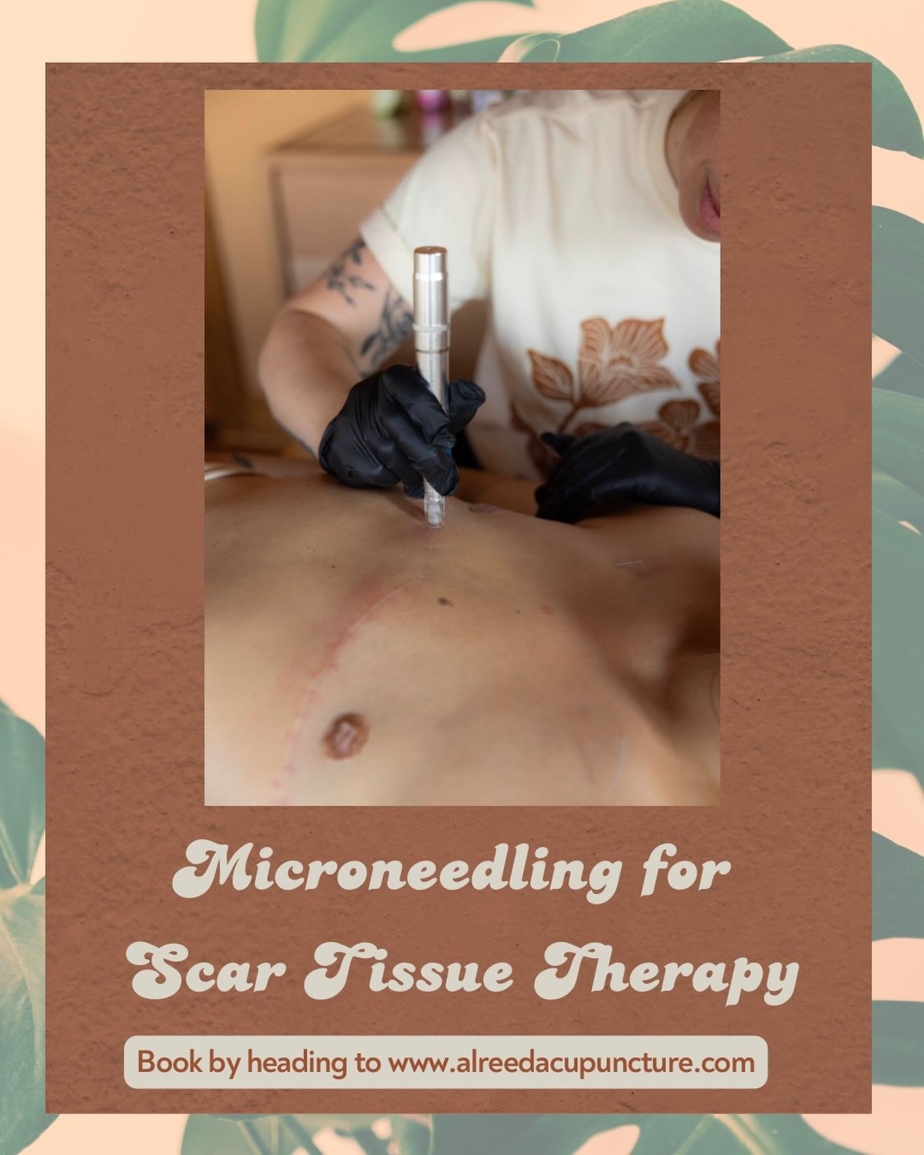 Microneedling for Scar Tissue Therapy ✨

I always love expanding what can be done with Acupuncture,

So why not do it will Microneedling? 

Microneedling&rsquo;s abilities with scar tissue therapy can be amazing- and be good for so many types of medi
