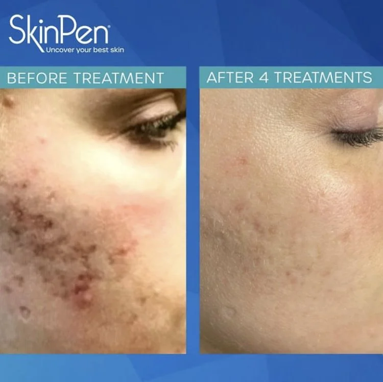 Skinpen before and after.jpg