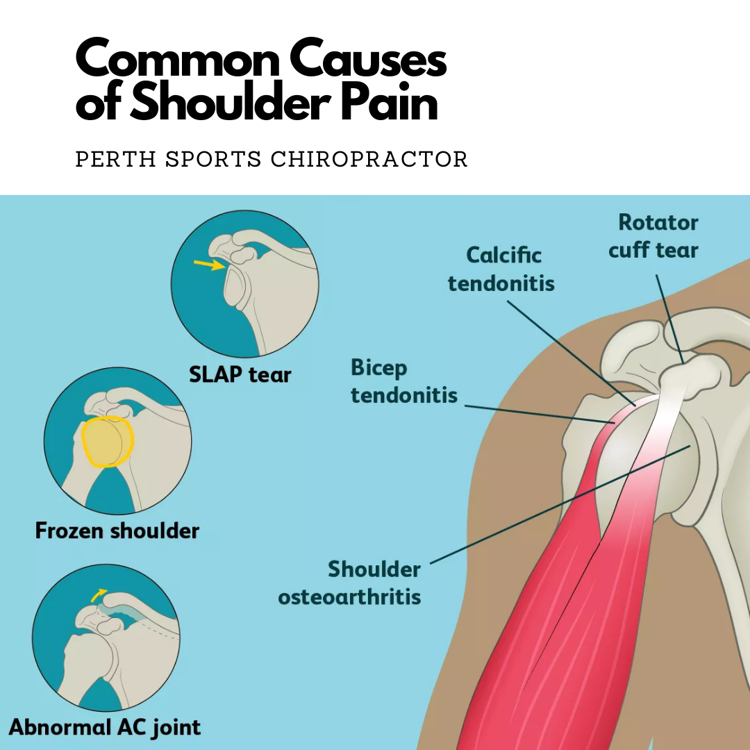 Shoulder Pain — Perth Sports Chiropractor Inglewood Chiropractor