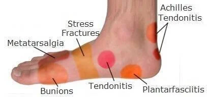 Inside Sole Heel Pain Inside Sole Feet Pain Lateral Pain On The