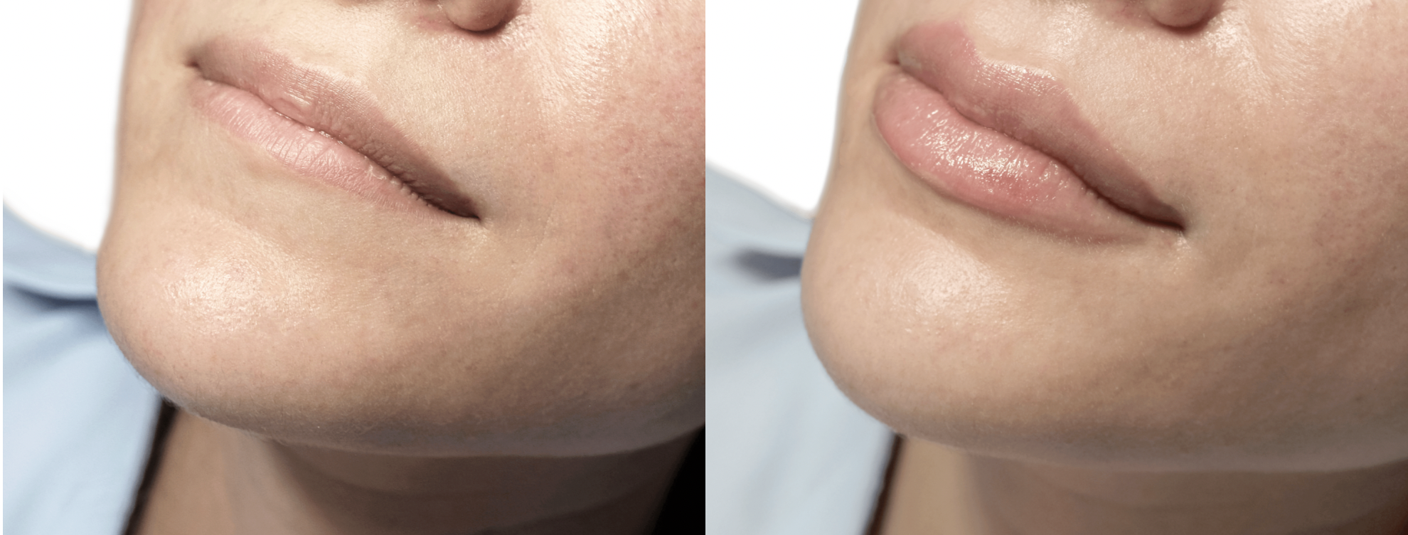 Dermal Fillers — Good Vibe Medical Wellness Spa