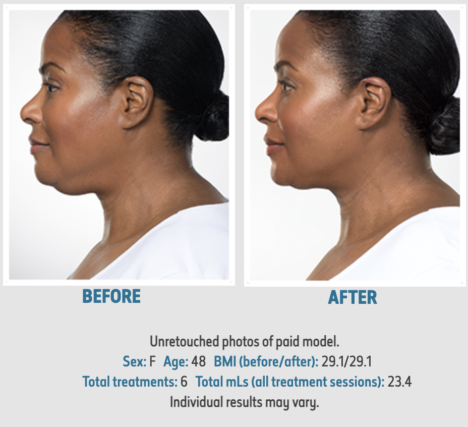 Kybella 6 treatments 1