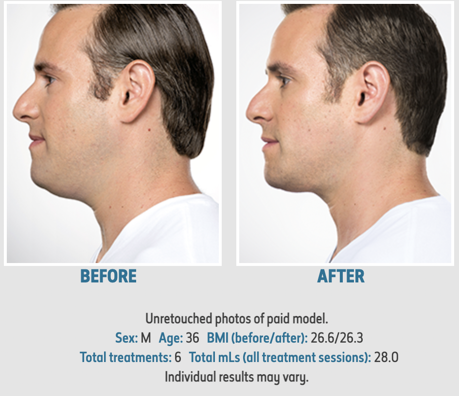 Kybella 6 treatments 3