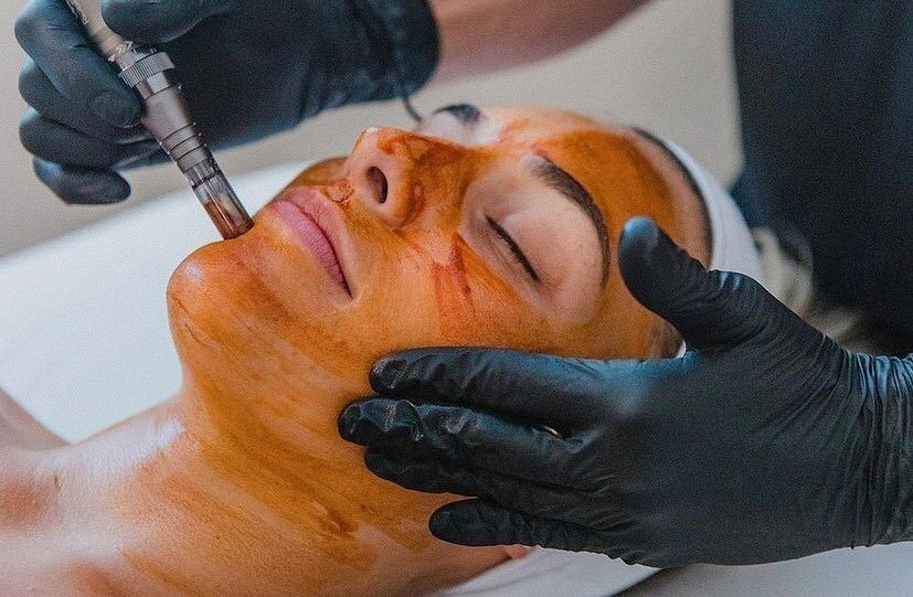 The Osmosis RevitaPen Facial Infusion 🙌🏼

It generates a 30-day collagen production increase and is a wonderful option alternative to micro-needling. 

RevitaPen works on same principle as micro-needling or CIT (collagen induction therapy). It pene