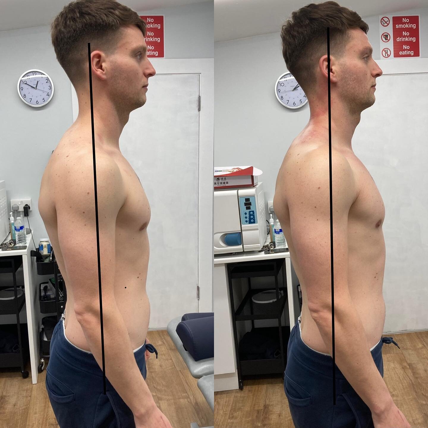 Full MOT posture fix up for @jackskeites . Jack reached out to me for some Y-strap treatment and a posture fix up. He travelled for 2 hours to see me 🚗💨. 

Jack drives diggers for a living and trains in the gym 4-5x per week. He noticed the develop