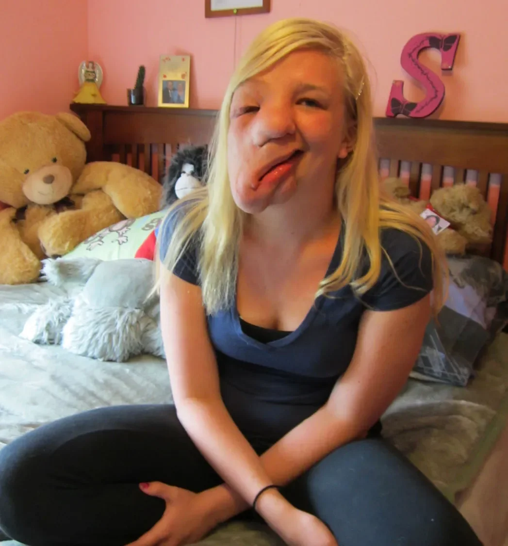 Girl With Half a Face - Documentary