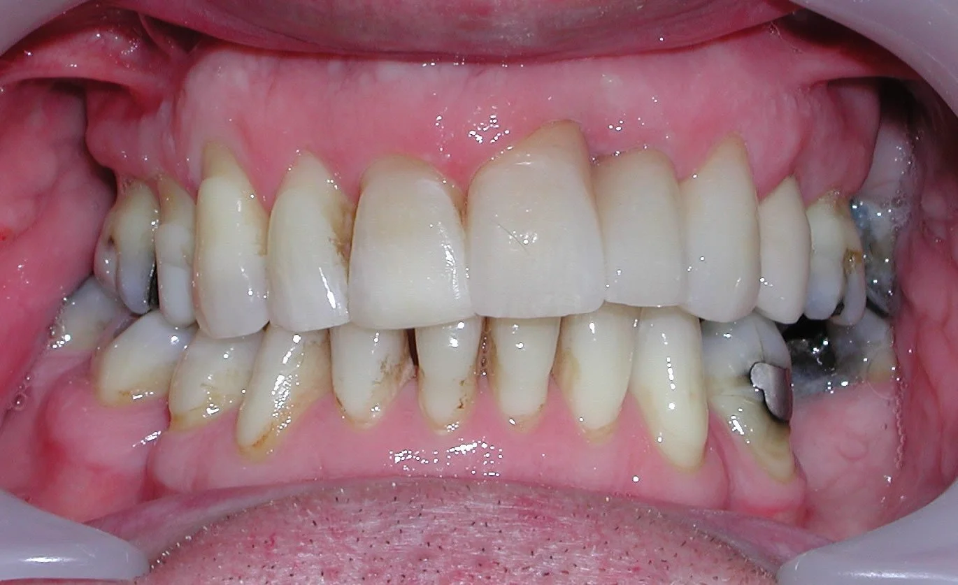 Example of dental crowns