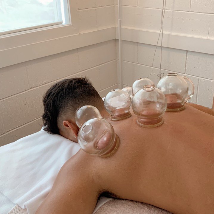 Some cupping therapy from the weekend to release upper back and shoulder tension.

#acupuncture #acupuncturist #cuppingtherapy #aucklandacupuncture #aucklandacupuncturist