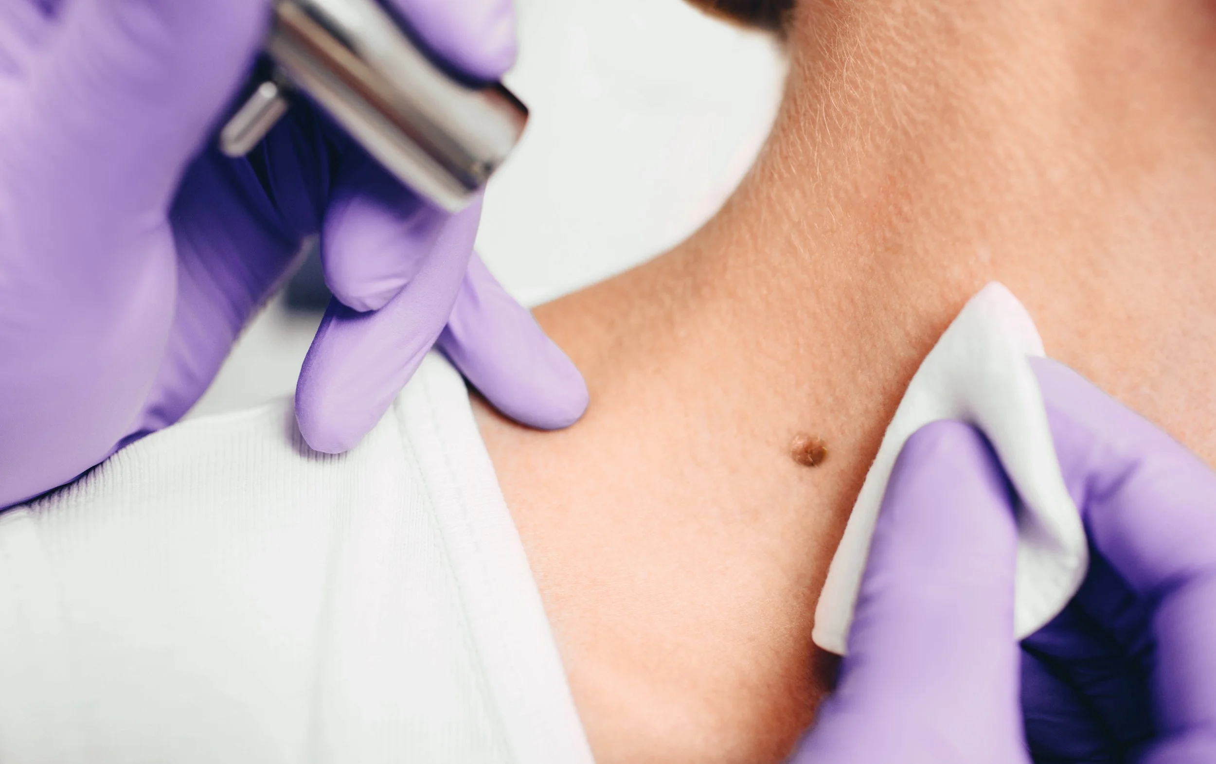 The Overlooked Signs of Skin Cancer and When to See a Professional