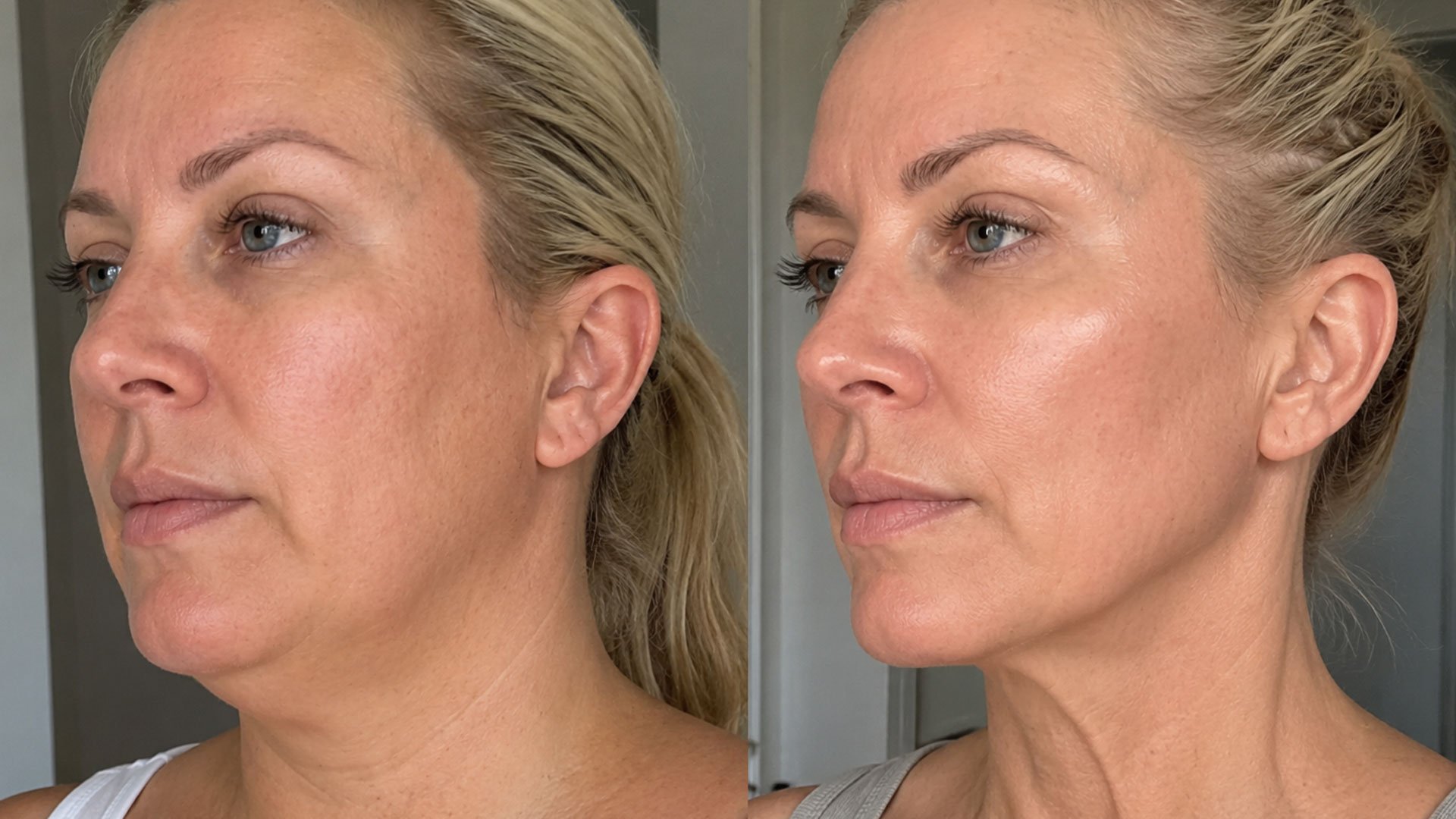 GLP1 Weight Loss and Facial Aging: How to Prevent Ozempic Face