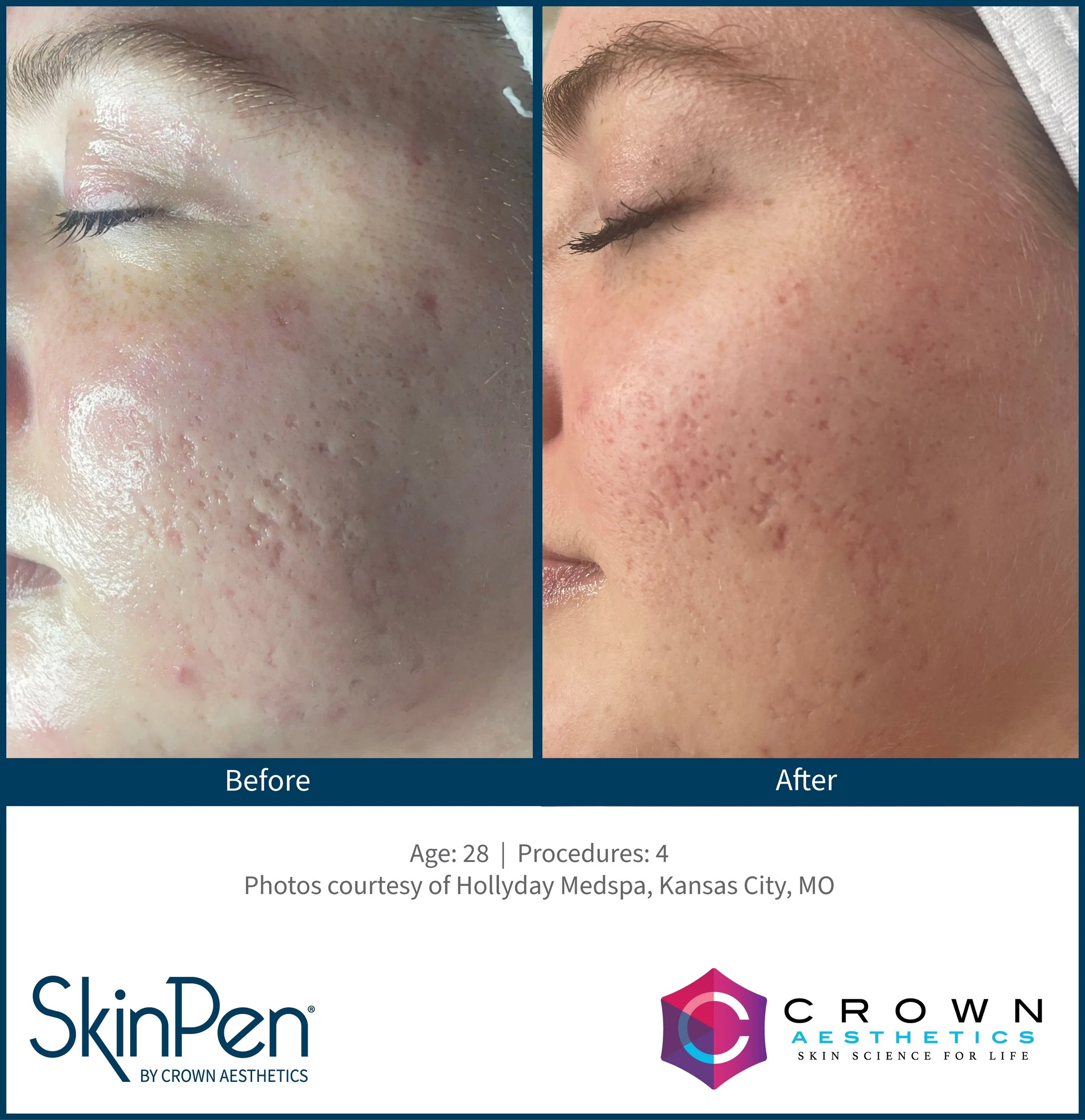 A before and after image showing the results of effective microneedling at Provenance Aesthetic & Wellness in Missouri City.