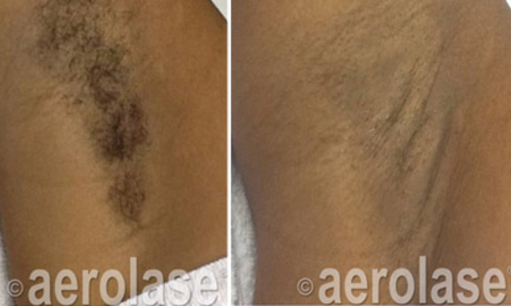 Aerolase Hair Removal
