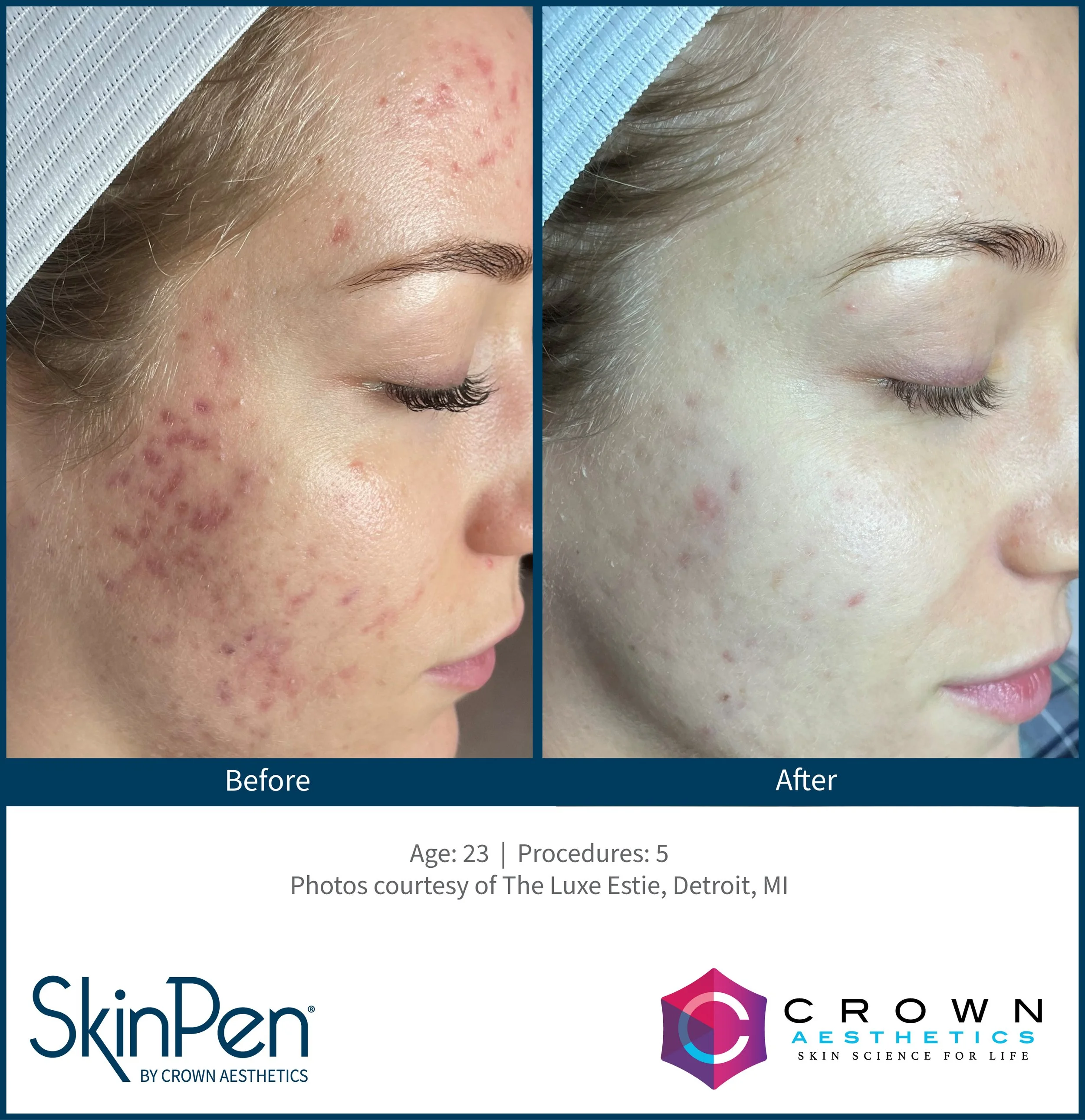Web_ProvenanceBA-SkinPen-TheLuxeEstie_Set4_Age23_Treatments5.jpg