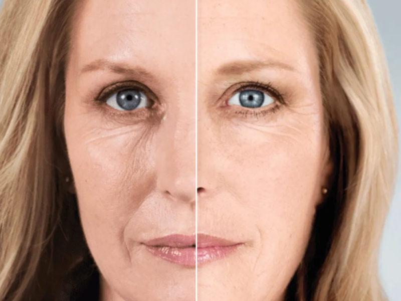 Sculptra Collagen