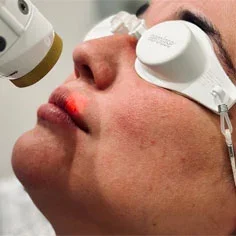 Aerolase Neo Eleite Laser Treatments