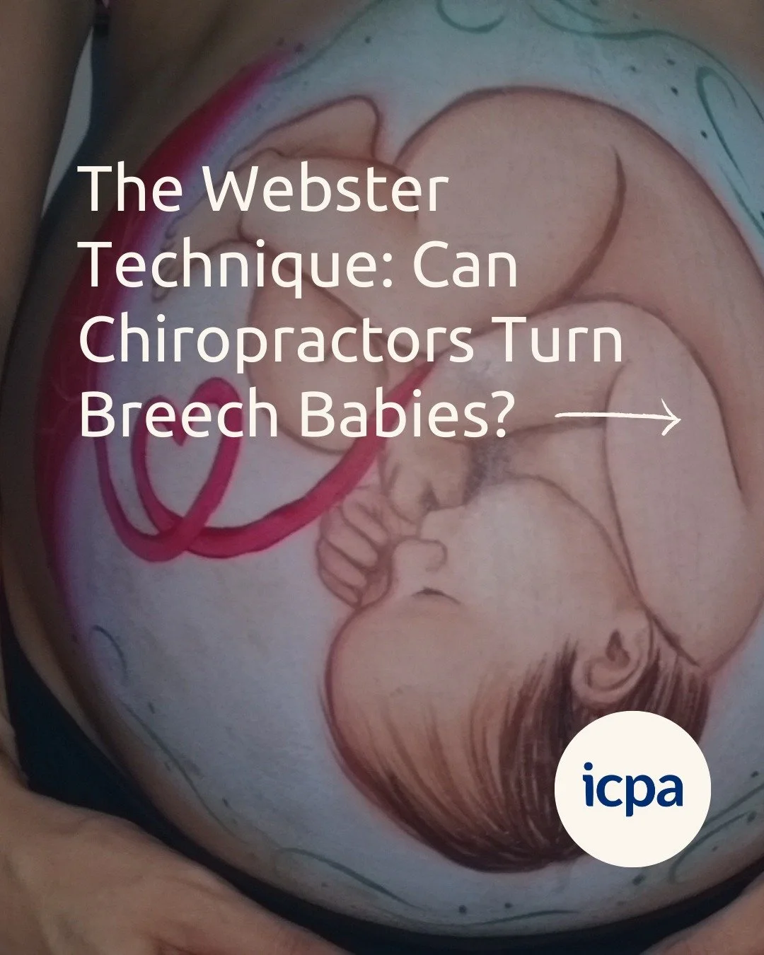 Have you ever been told that chiropractors turn breech babies? While a common misconception, this is not exactly true. Chiropractors use the Webster technique to balance mom's pelvis, creating space for the baby to move into their optimal position fo