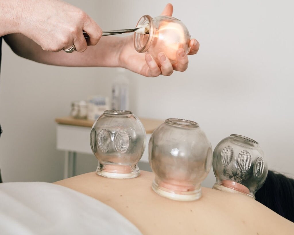 Cupping therapy is an ancient form of alternative medicine in which a therapist puts special cups on your skin for a few minutes to create suction. Did you know, when your skin turns red from the cup it's your body releasing toxins?⁠
⁠
Book an appoin