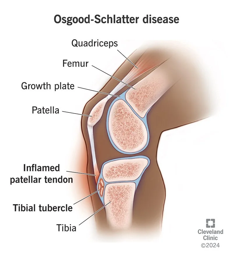 Osgood-Schlatter Disease: A Modern Approach to Knee Pain in Growing Athletes