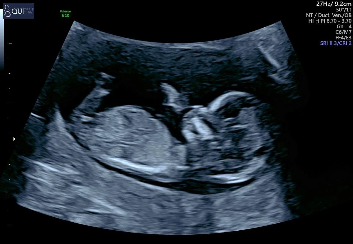 Ultrasound image showing a fetus in the womb, with visible head, body, and limbs.