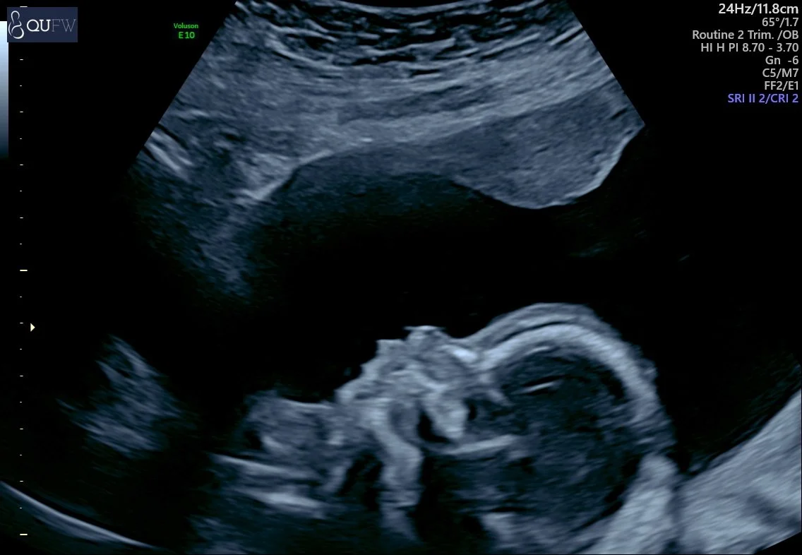 Ultrasound image of a fetus inside the womb.