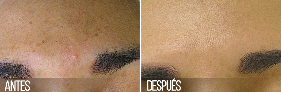 MANCHAS E HIPERPIGMENTACIÓN
Después de 4 sesiones.