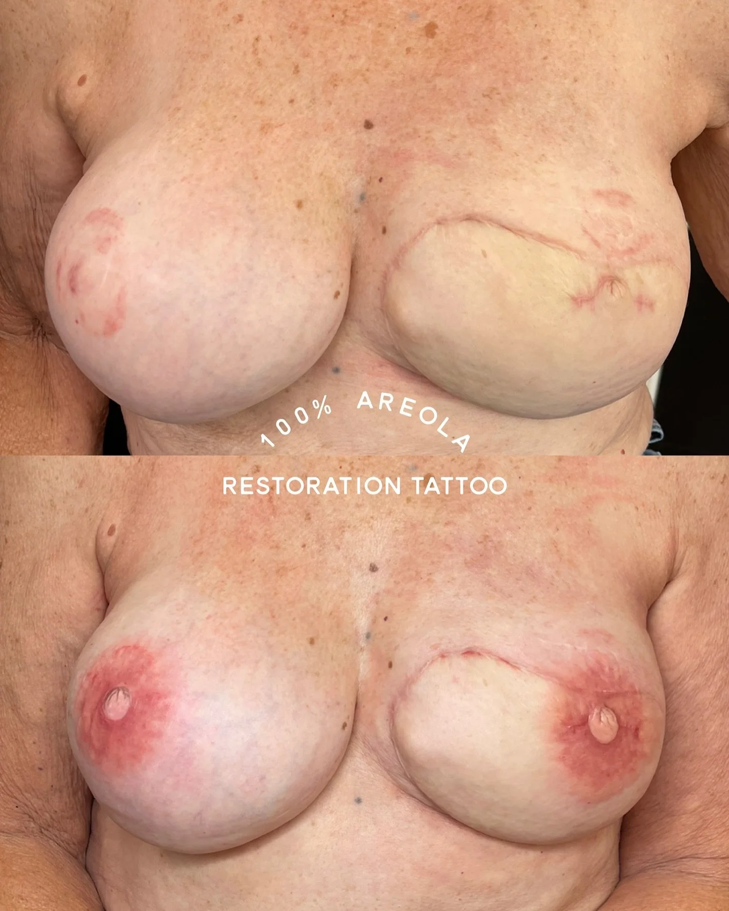 Areola restoration tattoos provide a powerful way to help women reclaim their confidence and feel whole again after breast cancer. If you know someone in need, please share our work with them! 💕