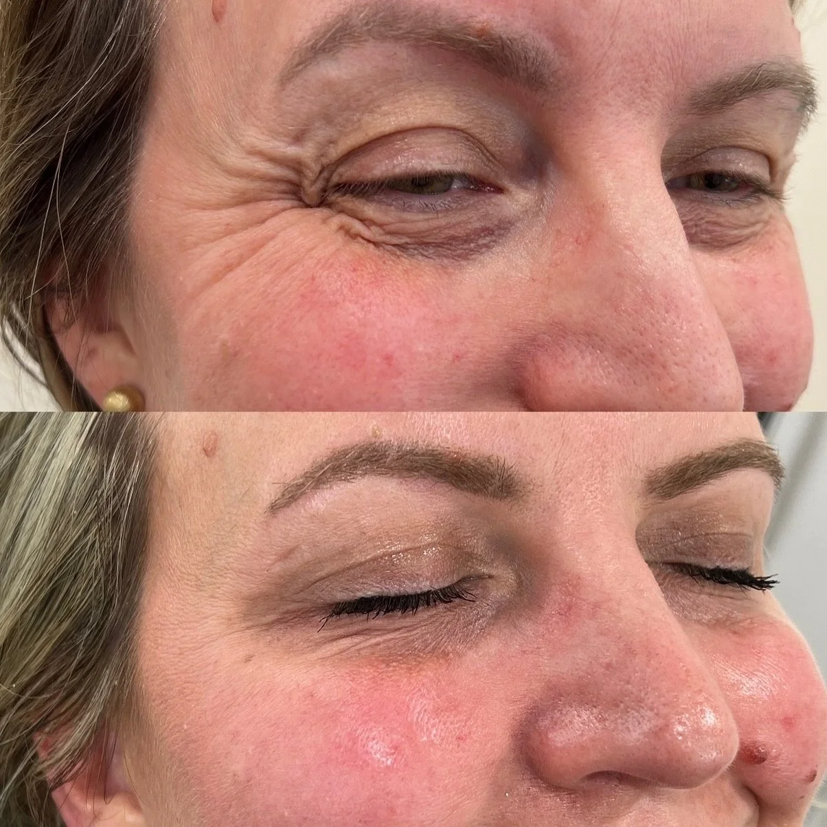 Amazing botox results on this beauty!!
Botox isn&rsquo;t about changing your face! It&rsquo;s about refreshing it! ✨💉
