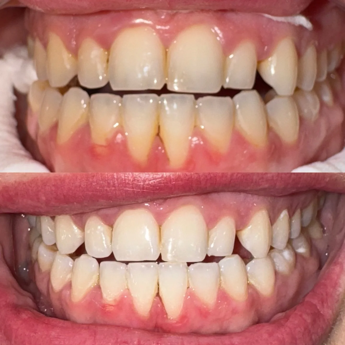 Swipe for the glow-up! These teeth whitening results speak for themselves! Brighter, whiter, and confidence boosted! ✨🦷
