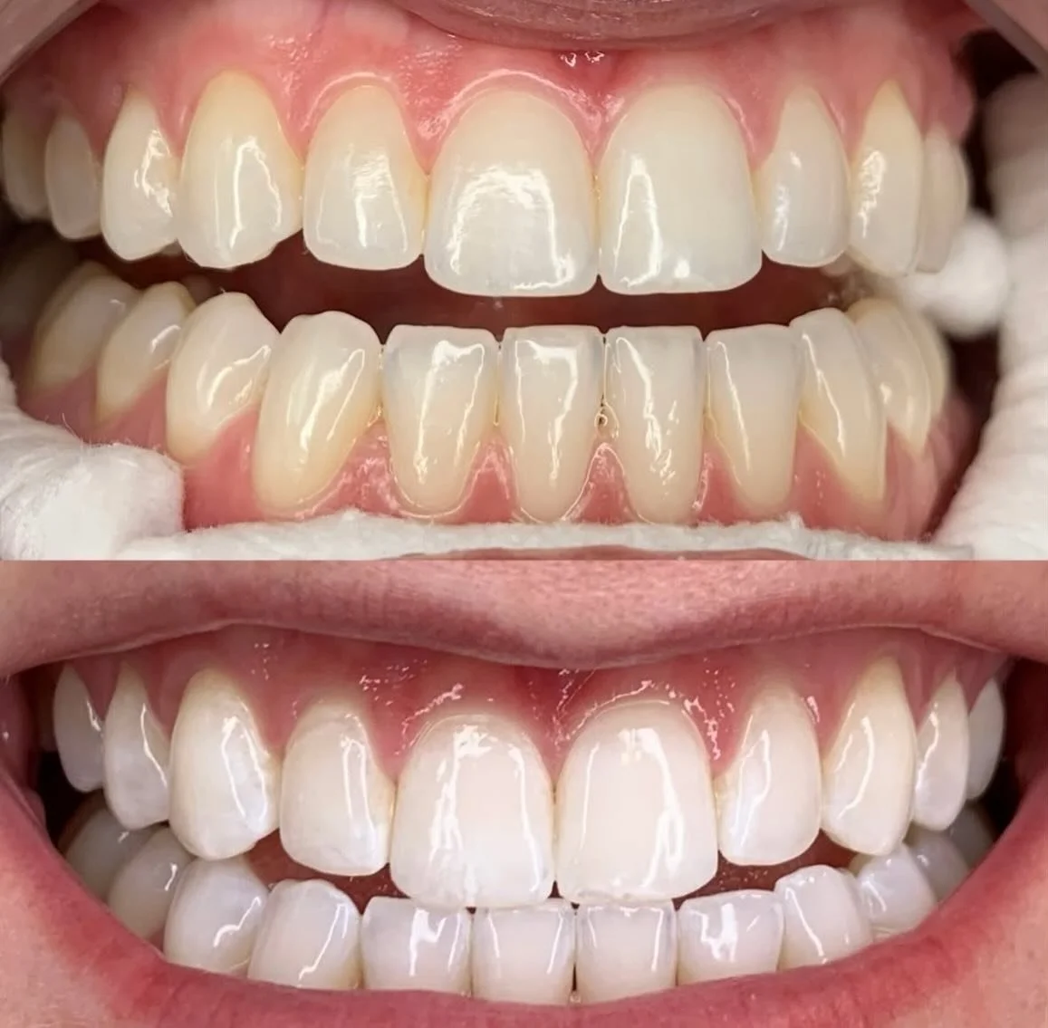 A whiter smile in just one session! Rachel working her magic again!! 
Swipe to see these stunning results! 🦷😁