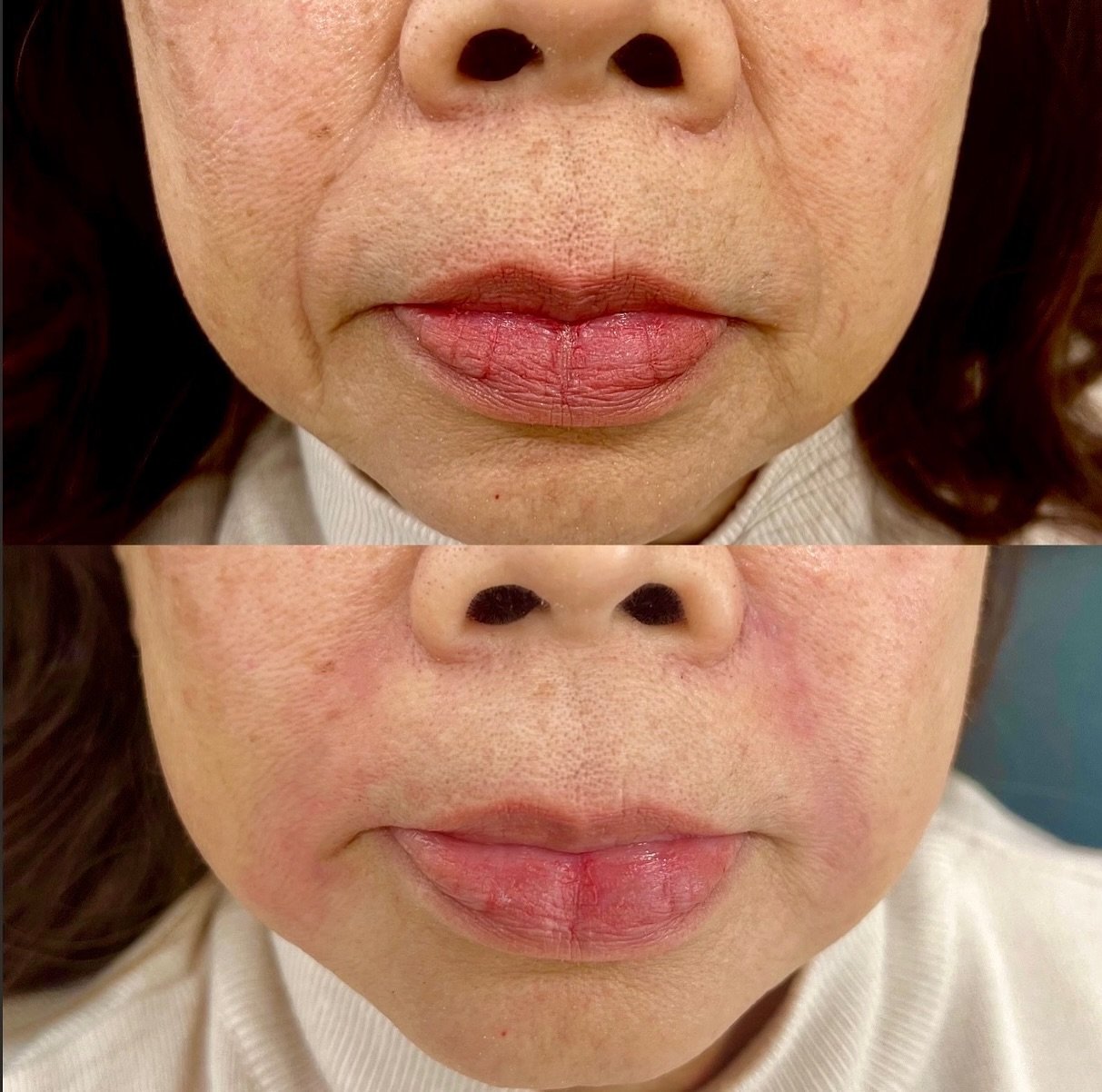 This Nasolabial filler Lynsey did is absolutely amazing! 
One syringe of filler erased years!💉✨